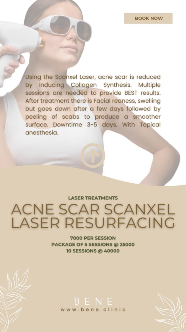 ACNE SCAR SCANXEL LASER RESURFACING